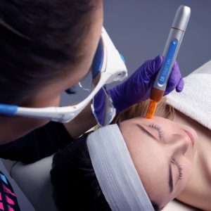 microneedling,kapsalon in enschede, schoonheidssalon in Enschede